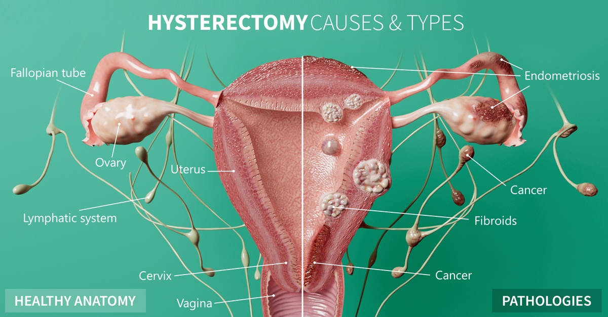 Healthy anatomy vs. Pathologies in female reproductive anatomy