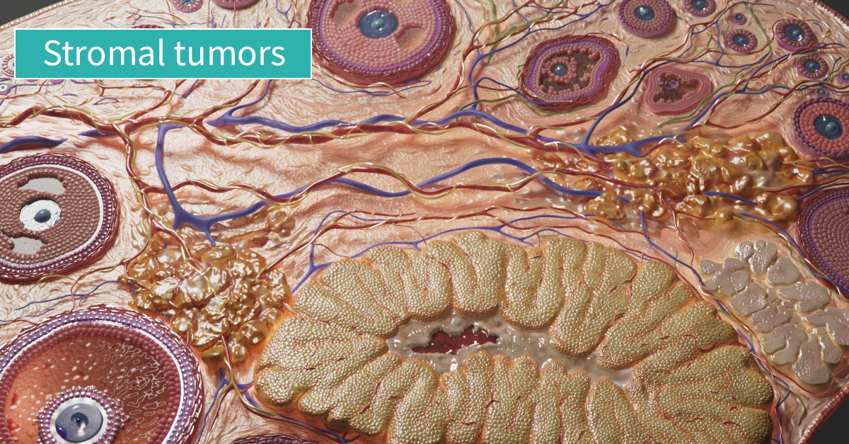 Stromal tumors