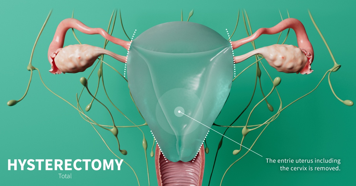Total hysterectomy