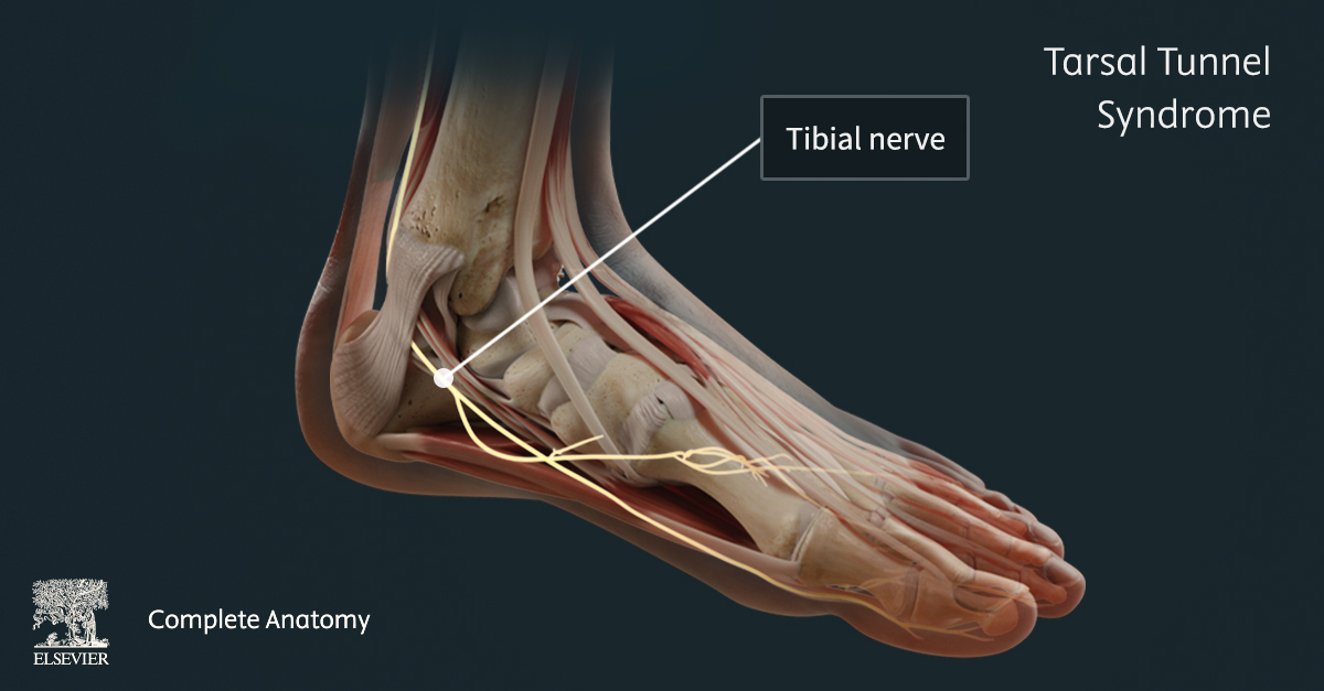 Image showing the foot with the skin faded to reveal the bones, muscles tendons and tibial nerve beneath.