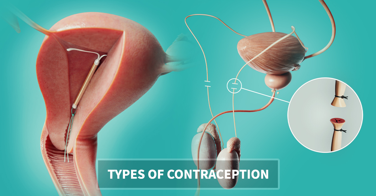 Types of contraception