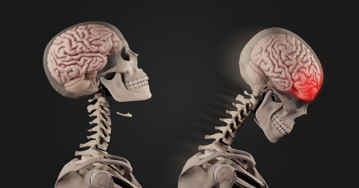 Side profile of the brain within the skull. On the left, the image shows the head tilting back. On the right, the image shows the head tilting forward, with the brain impacting against the skull.